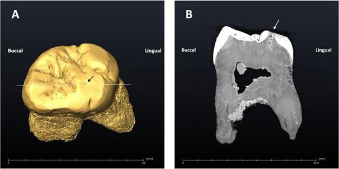 El curioso hábito de los neandertales que podría explicar la aparición de caries en sus dientes fósiles